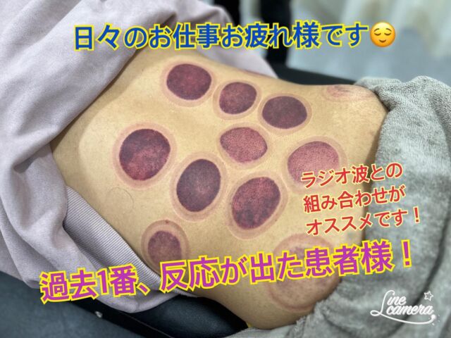腰に違和感が出たらカッピング♪

本日の患者様👱‍♂️

痛い！まではいかないけど、腰に違和感がありました。
触診させていただいた所、筋肉の張り感が強かったため、筋肉のもみほぐし＋ラジオ波＋カッピングにて施術！

過去1番の反応が出ました🙆‍♂️
日々のお仕事お疲れ様です😊

ラジオ波やカッピングは、冷え性、便秘、交通事故後の早期回復を目指す方にもオススメしてます♪

疲労、痛みにお悩みなら、当院にご相談下さい😊

当院では症状、お悩み、により施術内容がガラリと変わる
「オーダーメイド施術」を行っております。
施術内容、料金にご納得いただいた上で施術いたしますので、ご安心下さい😊

施術途中でも気になる事がありましたら、お気軽にご相談くださいませ✨

【住所】
〒850-0875 長崎市栄町6-19 ステップビル4階　
【営業時間】
水〜日　
10:00~14:00
16:00~20:00
 月・祝　
10:00~15:00 
【定休日】火曜　
【TEL】:095-807-0551 
【LINE】＠330krpxi

#sakura整骨院 #sakura接骨院 #痩身  #体質改善　#美容整体　#ラジオ波  #整骨院 #接骨院 #骨盤矯正 #猫背矯正 #腰痛  #肩こり  #冷え性  #ハイボルト  #交通事故　#カッピング  #吸玉　#疲労 #長崎市